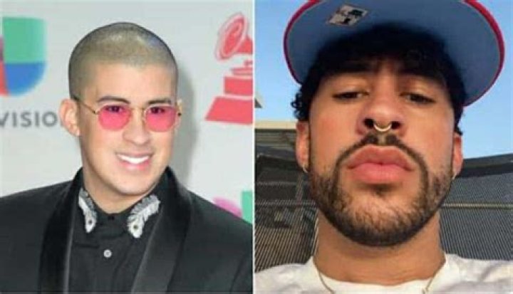 Bad Bunny Before Surgery