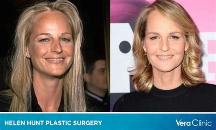 What Happened To Helen Hunt Face? Has She Done Plastic Surgery